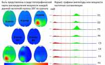 ЭЭГ при эпилепсии: расшифровка результатов. Признаки эпилепсии на ЭЭГ