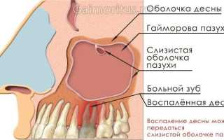 Симптомы и лечение одонтогенного гайморита