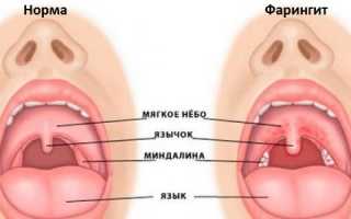 Нужны ли антибиотики для лечения фарингита?