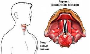 Ларингит: что собой представляет и передается ли или нет?