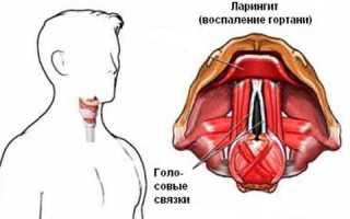 Ларингит: что собой представляет и передается ли или нет?