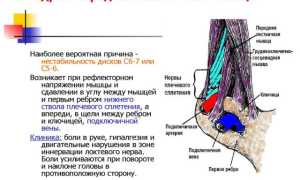 Синдром передней лестничной мышцы: симптомы и лечение скаленус-синдрома