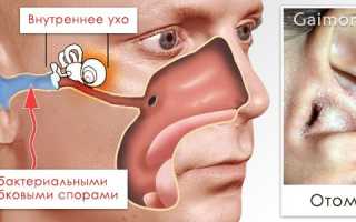 Грибок ушей у человека – какими препаратами это лечится?