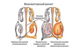 Проявления фронтита и особенности его лечения