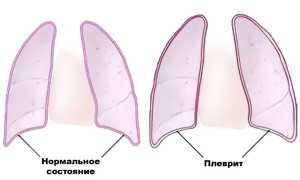 Популярные средства для лечения плеврита в домашних условиях