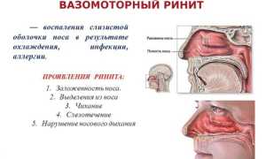 Особенности хирургических вмешательств при вазомоторном рините