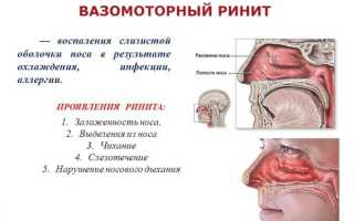 Особенности хирургических вмешательств при вазомоторном рините