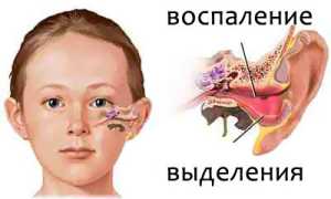 Антибактериальная терапия при воспалении уха в детском возрасте: препараты и их применение
