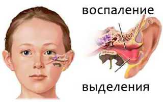 Антибактериальная терапия при воспалении уха в детском возрасте: препараты и их применение