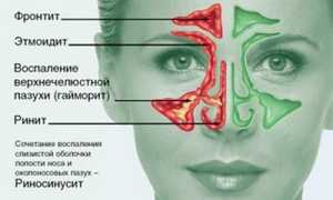 Когда и как применяются антибиотики в терапии фронтита?