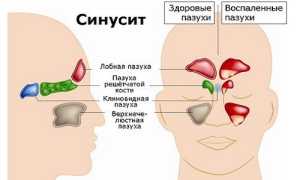 Синусит аллергического происхождения: особенности, симптомы, тактика лечения