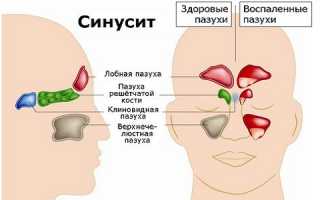 Синусит аллергического происхождения: особенности, симптомы, тактика лечения