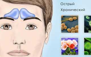 Как определить и вылечить фронтит?