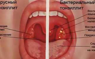 Как лечить хронический тонзиллит и защитить себя от осложнений?