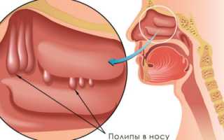 Проявления, методы диагностики и лечение пристеночного гайморита