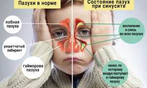 Ринит, гайморит и синусит: отличия, симптомы, лечение