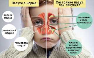 Ринит, гайморит и синусит: отличия, симптомы, лечение