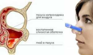 Гайморит: симптоматика и терапия катаральной формы