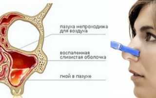 Гайморит: симптоматика и терапия катаральной формы