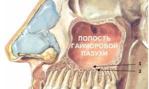 Связан ли гайморит с гигиеной полости рта?