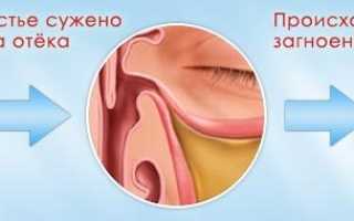 Первые признаки гайморита у взрослых