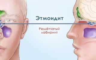 Этмоидит, его разновидности – лечение острой и хронической стадии