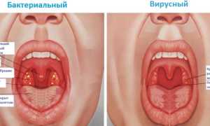 Тонзиллит: что собой представляет и какие причины развития?