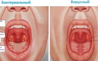 Тонзиллит: что собой представляет и какие причины развития?