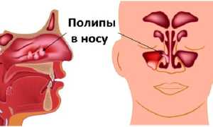 Лечение полипоза назальными каплями и спреем: эффективно ли это?