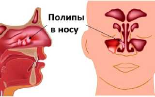 Лечение полипоза назальными каплями и спреем: эффективно ли это?