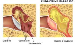 Причины возникновения экссудативного отита, симптоматика и терапия