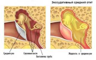 Причины возникновения экссудативного отита, симптоматика и терапия
