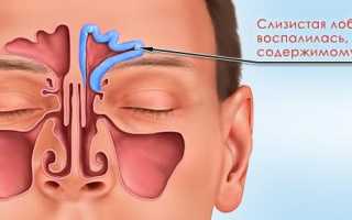 Лечим катаральный фронтит за несколько дней