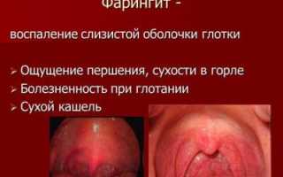 Фарингит в детском возрасте: симптомы, лечение, профилактика, осложнения