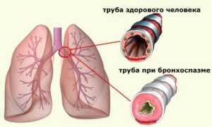 Механизм развития и симптомы бронхоспазма