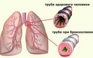 Механизм развития и симптомы бронхоспазма