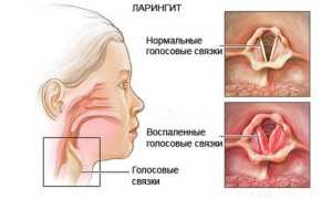 Симптомы, диагностика и терапия ларингита с хроническим течением