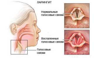 Симптомы, диагностика и терапия ларингита с хроническим течением