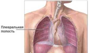 Плеврит легких у взрослых
