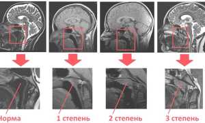 Аденоиды первой степени у детей: основные симптомы и методы лечения