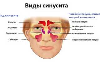 Как распознать «сигналы» опасной болезни – синусита?