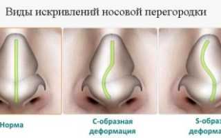 Септопластика: виды и методика проведения