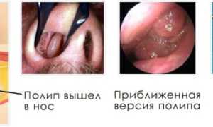 Синусит катаральной формы: то, что нужно знать о болезни