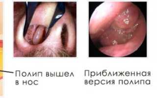 Синусит катаральной формы: то, что нужно знать о болезни