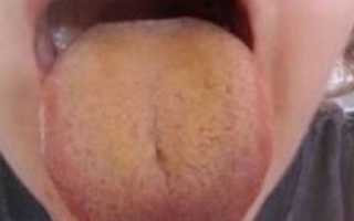 Почему бывает желтый язык и горечь во рту? Причины и лечение