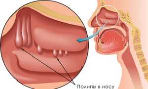 Полипы в носу: как выявить и как лечить?