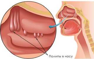 Полипы в носу: как выявить и как лечить?