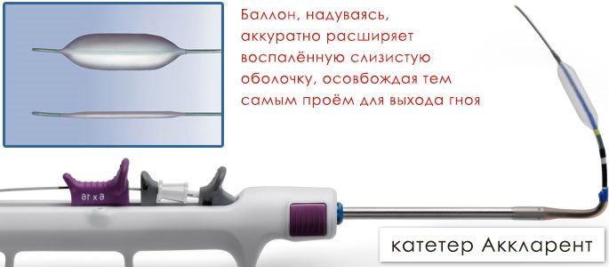 Баллонный катетер аккларент