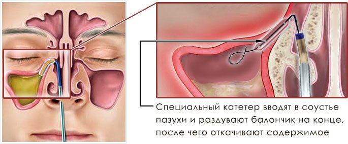 Схема балонной синусопластики