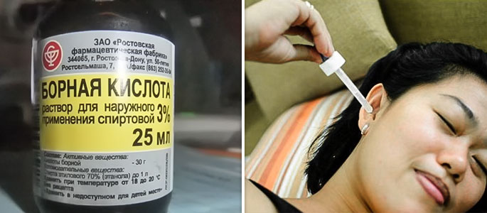 Закапывание борной кислоты в уши